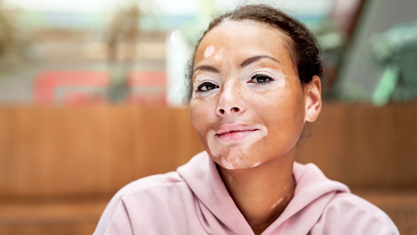 An image of autoimmune diseases treatment at Indimasi ayurvedic healing Village